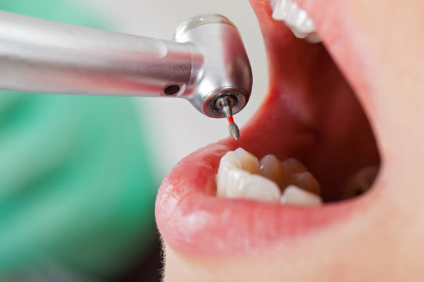 Best Emergency Root Canal Treatment in Pflugerville, TX